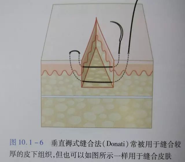 刀口闭合需要多久,伤口闭合除了缝针还有什么方法