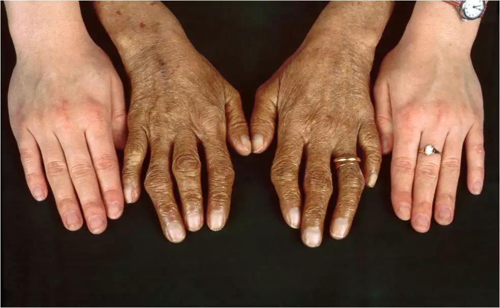 补铁过量伤肝的危害,孕妇补铁过量表现