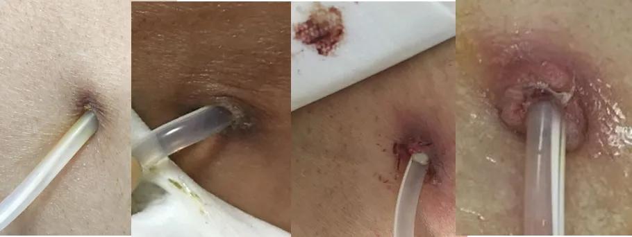 腹膜透析出现腹膜炎的护理措施,腹膜透析居家关注事项