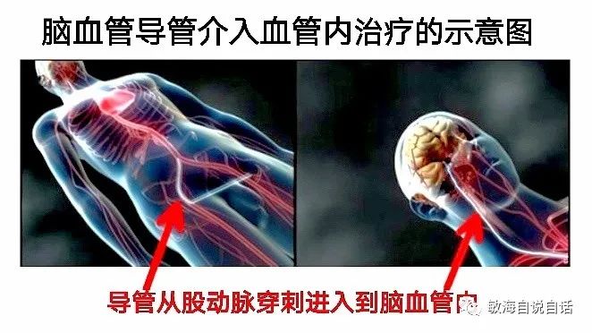 2021脑梗塞取栓治疗指南,脑梗塞取栓治疗适应症