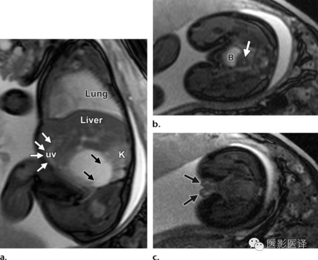 胎儿卵巢囊肿5.6厘米会消失吗,卵巢巨大囊肿与妊娠鉴别