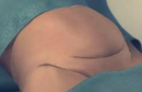 剖腹产手术报告单,剖腹产手术全部流程看完泪奔