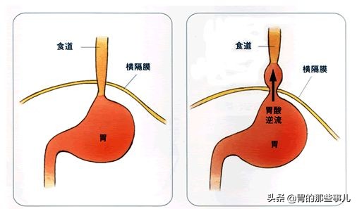胃炎快速治疗的方法是什么,儿童慢性胃炎怎么治疗恢复得快