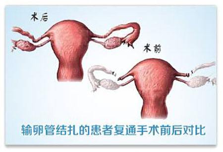 结扎了输卵管还可以复通吗,输卵管结扎后还可以复通吗