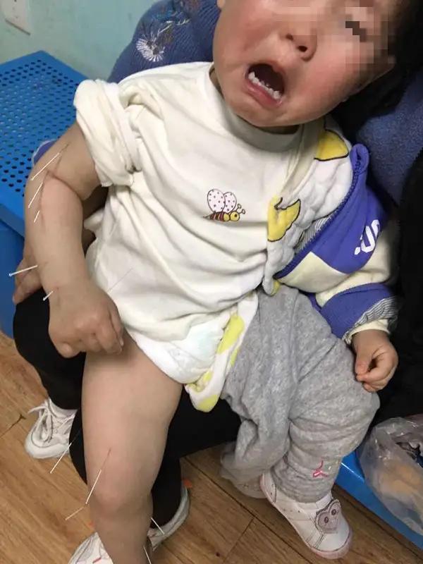 小孩打过脑瘫疫苗有啥症状,打疫苗脑瘫怎么办