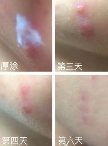 超好用的祛痘膏便宜,有没有好用的祛痘膏推荐女孩子