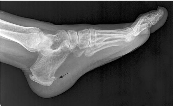 足底感觉有刺痛感是足底筋膜炎吗,路走多了脚底板疼可以用冰敷嘛