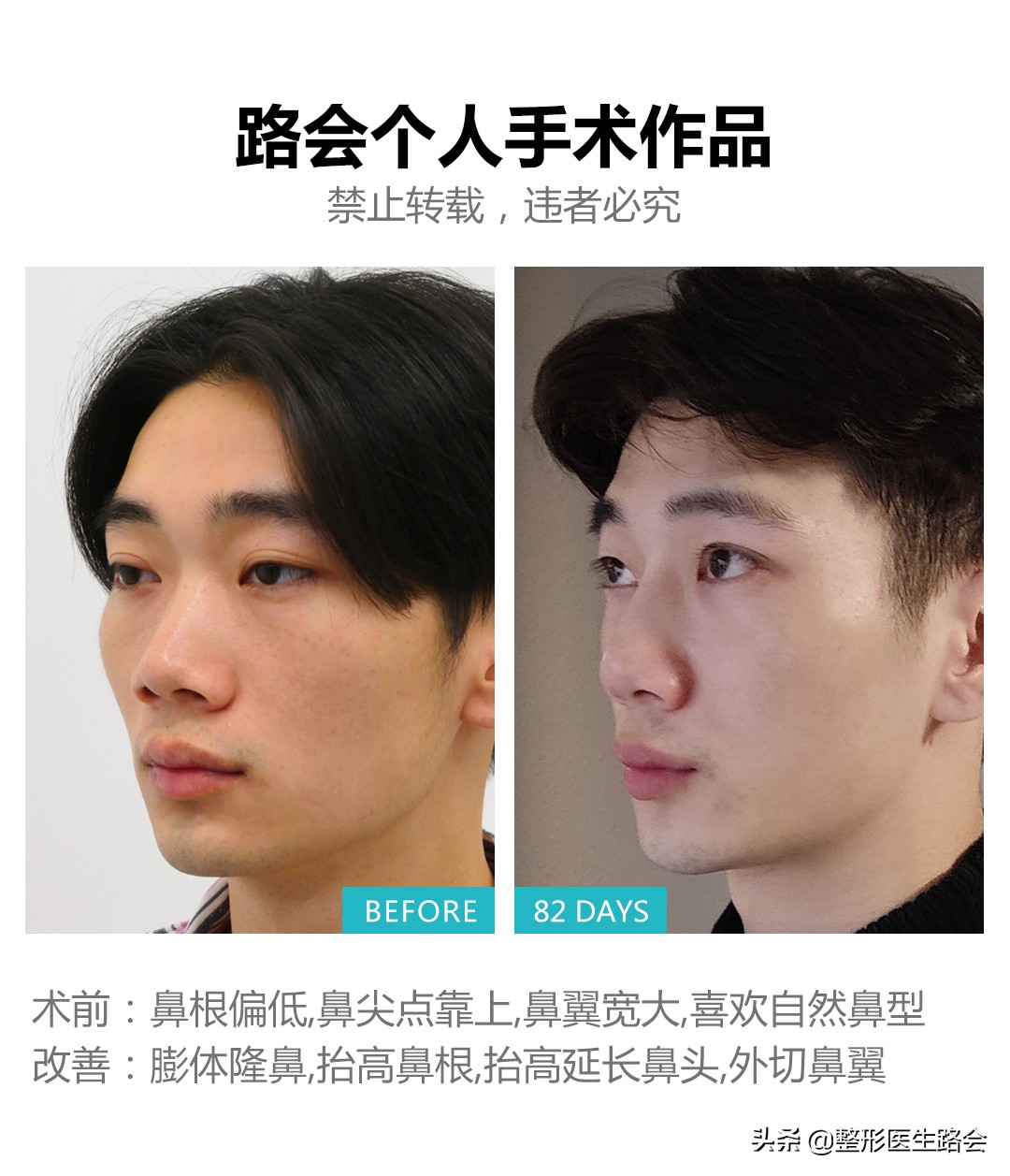 隆鼻后鼻子可以动吗,隆鼻后鼻子里可以不塞纱布吗