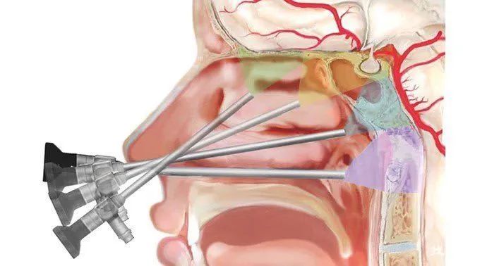 脑子里有4毫米的瘤,脑子里为什么会长瘤