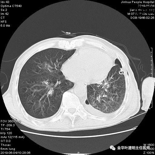肺手术后乳糜胸是医疗事故吗,肺部切除后乳糜胸治好了