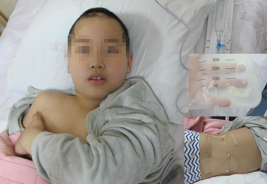 儿童脑出血昏迷三天后恢复正常了,脑出血后脑积水多久会出现症状