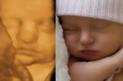 四维彩超图片孩子少一块,四维彩超图看孩子准确