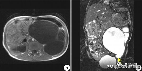 泌尿系统26种症状,泌尿系统的各疾病的体征汇总