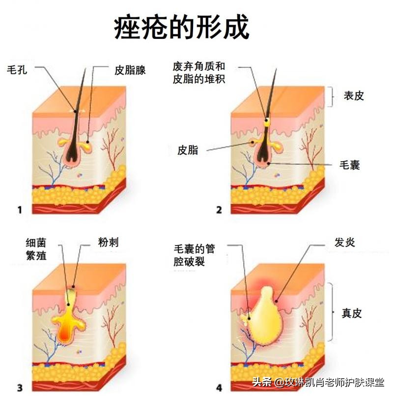 额头下巴后背长痘痘是怎么回事,额头下巴下颌线长痘是什么原因