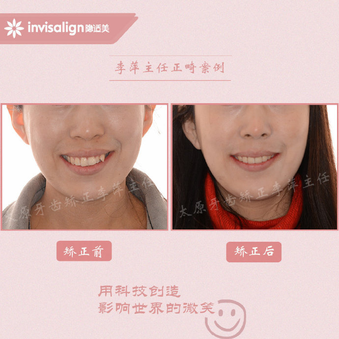 二甲医院骨性前突龅牙矫正多少钱,太原骨性嘴凸矫正牙齿图片