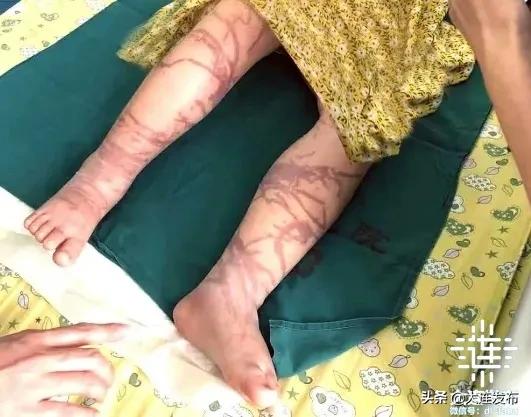 幼儿被马蜂蜇伤的新闻,孩子被蜜蜂蜇伤怎么正确处理