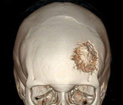 脑膜瘤有些什么症状,脑膜瘤症状有哪些啊