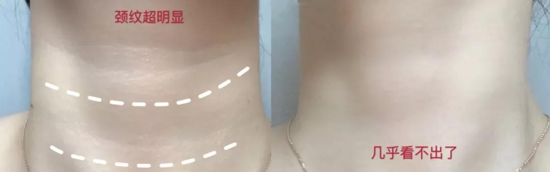 有颈纹和没有颈纹的女人,女人有颈纹怎么办