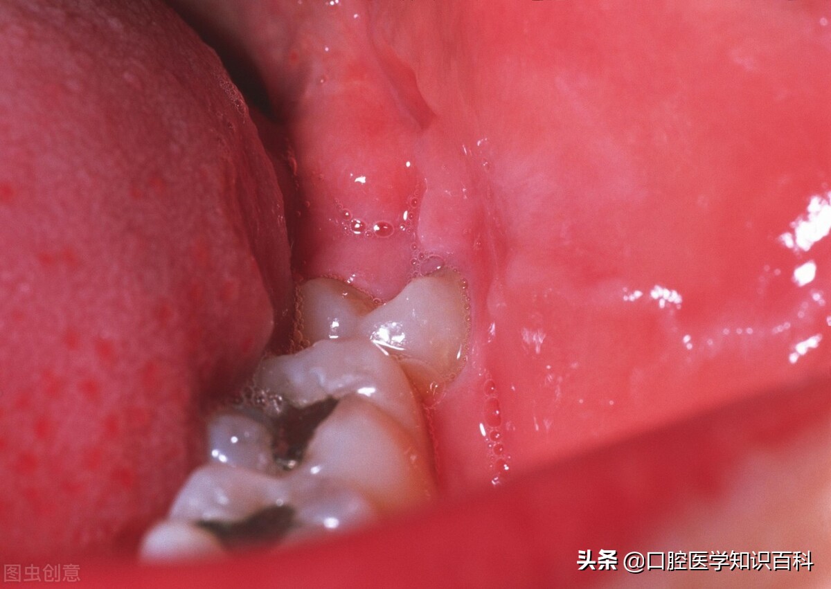 拔掉智齿和第二磨牙怎样修复,智齿拔除后的关注事项和禁忌