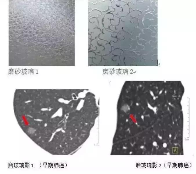 肺部小结节是什么，是早期肺癌吗？可以吃药治愈或者消失吗？
