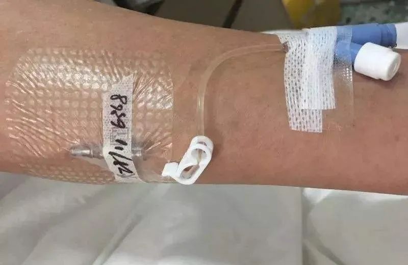 关于留置针的科普,留置针的四大关注事项