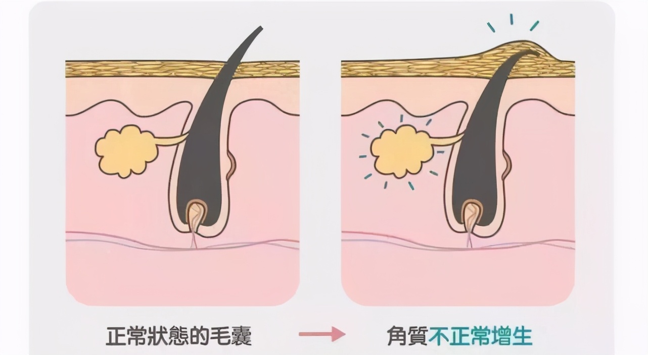 长汗毛导致的鸡皮肤怎么办,女生有鸡皮肤的解决方法