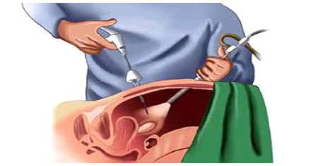 切口小，外观佳，恢复快——治疗疝气，了解下腹腔镜疝修补术