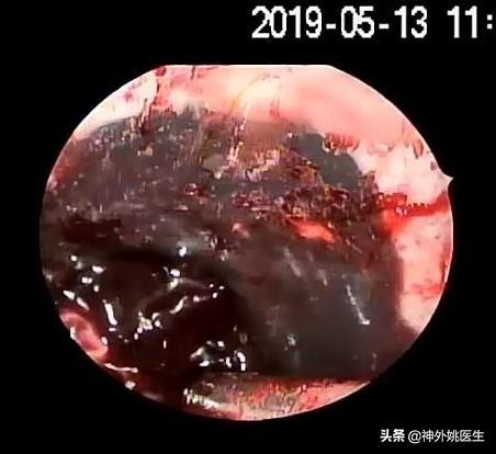 微创手术后血肿是什么,颅内血肿微创清除术多少钱