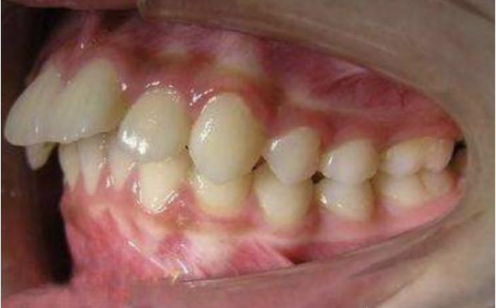 骨性龅牙怎么弄,如何判断骨性龅牙的轻重程度