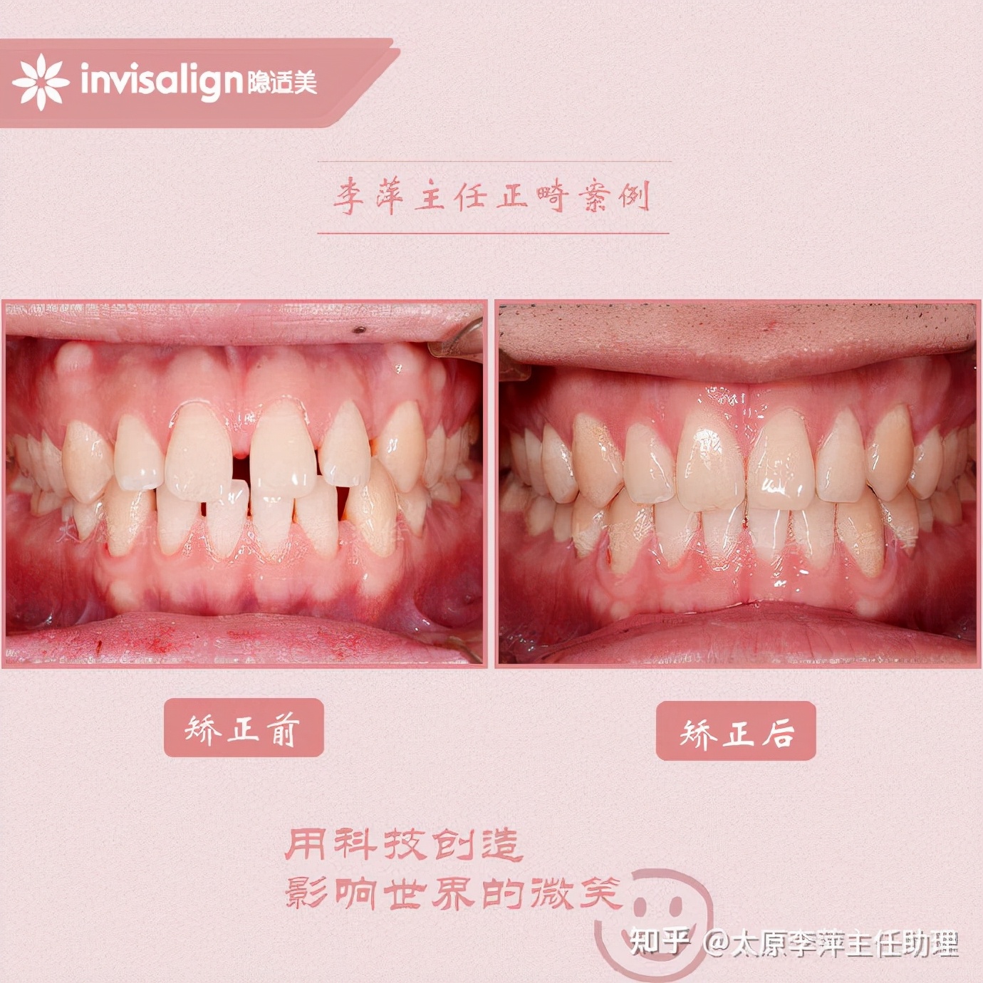 太原牙齿矫正靠谱吗,太原成人隐形牙套牙齿不齐