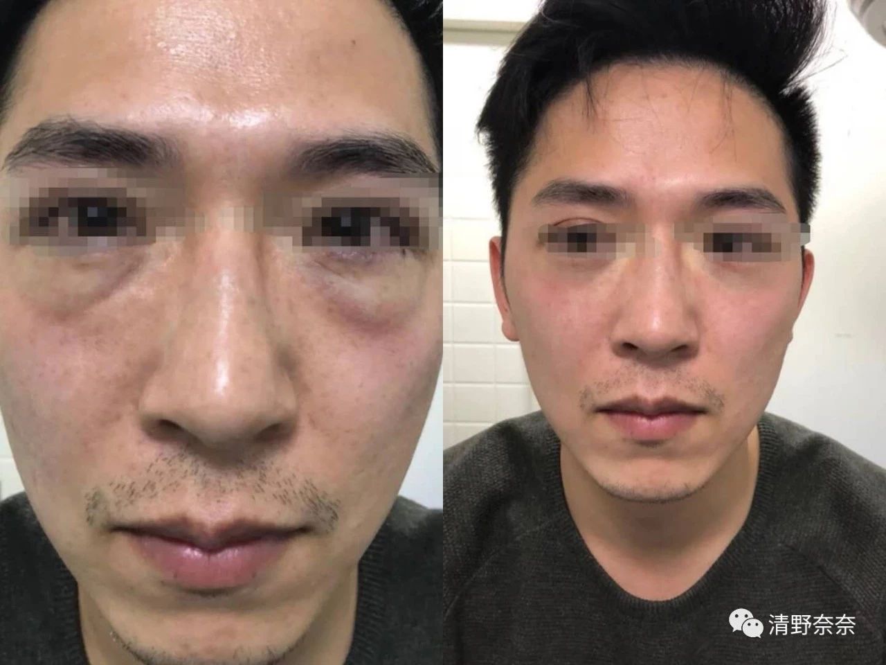 别光用眼霜！专家提醒：要想去除眼纹黑眼圈，这些方法最有效