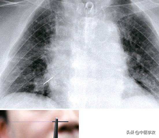 针灸过程中病症加重是什么原因,针灸异常情况的处理