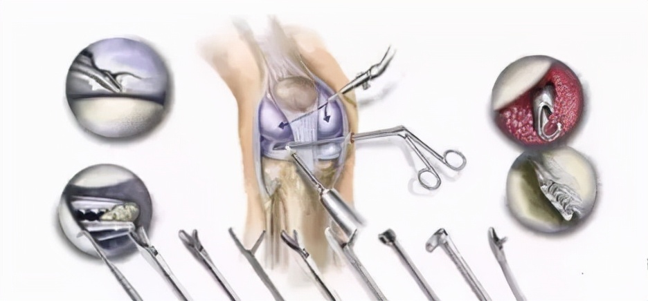 关节镜的适应症是什么,关节镜操作流程及关注事项