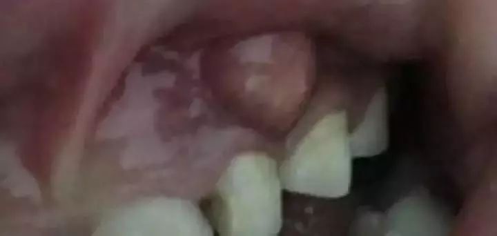 修复一颗蛀牙的全过程,蛀牙早期黑点全治好了的感觉真好