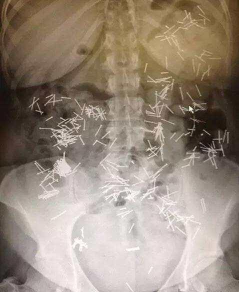 不作死就不会死,看看这些被人类搞进身体里的异物