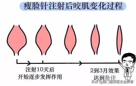 保妥适效果怎么样呢,保妥适是玻尿酸还是肉毒素