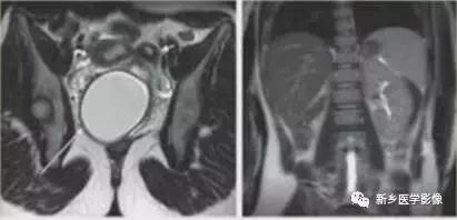 子宫发育异常，应想到的6大类常见畸形