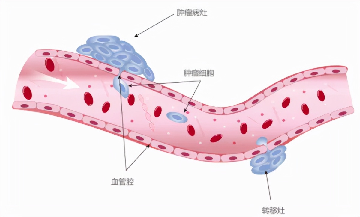 循环肿瘤细胞ctc检测技术,循环肿瘤细胞ctc检测阴性率