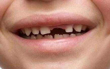 儿童一颗恒牙长一半很久不长了,19岁乳牙不掉不长恒牙的危害