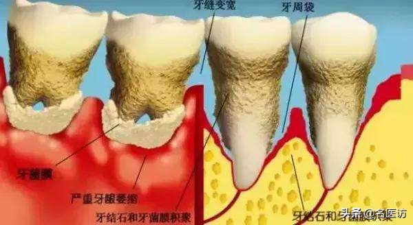 牙疼牙周炎的治疗方法,中医治疗牙周炎好方法