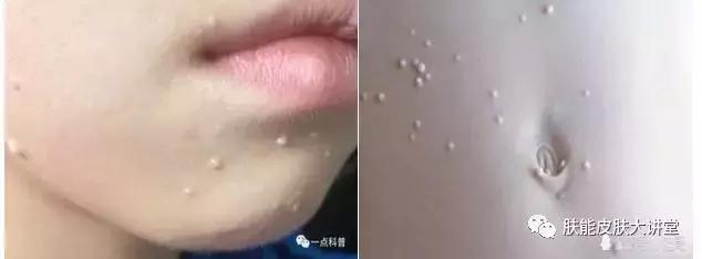 传染性软疣为何叫水瘊子,水瘊子和传染性软疣一样吗