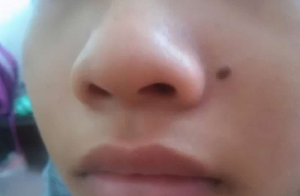 8个月的宝宝脸上长痣是什么原因,宝宝脸上长了痣会变大吗