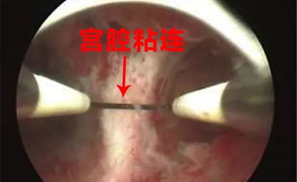 反复异常阴道出血？这个检查你需要做