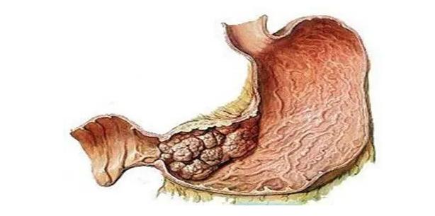腹腔镜胃癌新技术新项目汇报,腹腔镜胃肠手术新技术