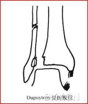 所有骨折都叫什么名字,骨折的名称有哪些