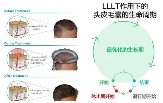 如何挽救脱发,父亲脱发怎么挽救