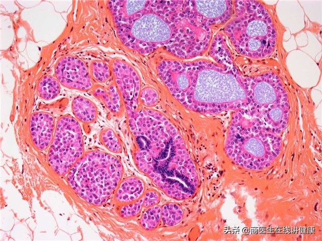 几个月内形成的浸润癌易复发么,浸润癌恶性