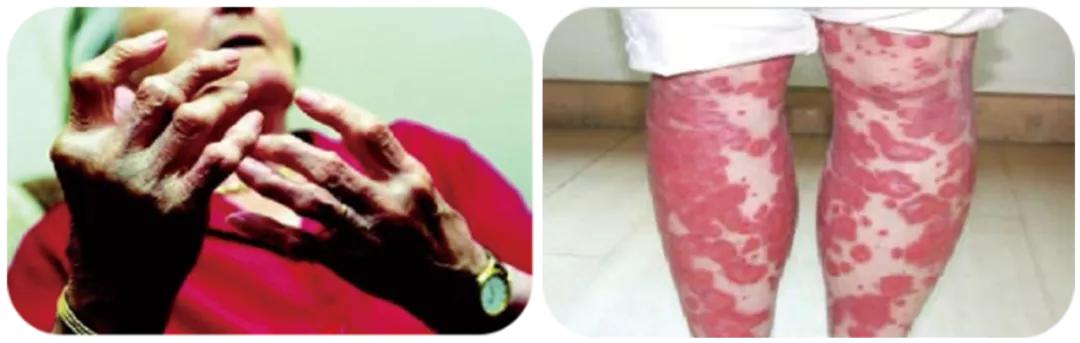 北京大学滨海医院皮肤科开设银屑病专病门诊