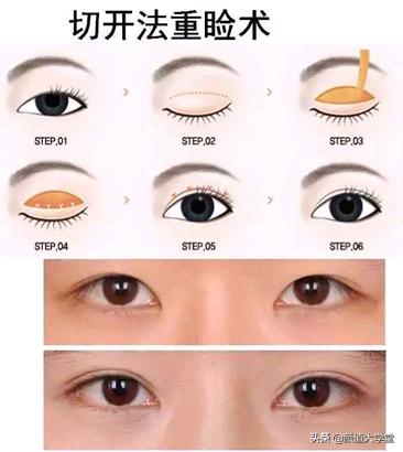 长期贴双眼皮的危害,贴几次双眼皮贴会导致眼皮松弛