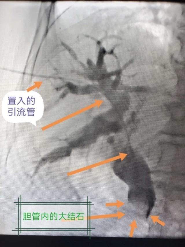 92岁老人多病缠身又遇高热腹痛,大人高热不退怎么处理治疗